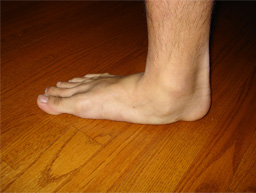 Flat Feet / Pes Planus
