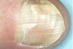 fungal infections of the toe nail