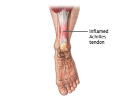 inflammed-achilles-tendon